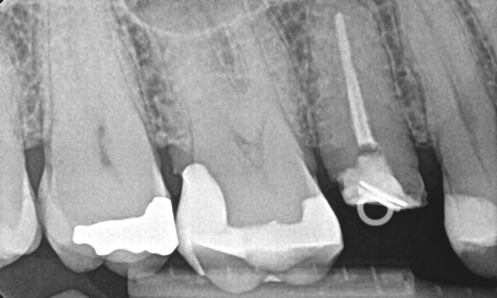 Egen tann istedenfor implantat